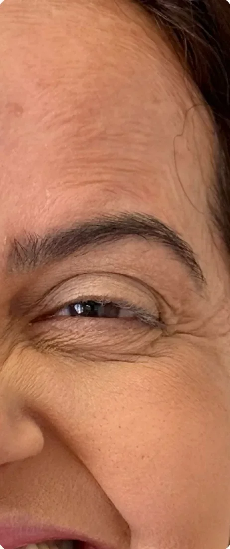 Antes: Suavizar as linhas ao redor dos olhos. Toxina botulínica, Dra. Marina Albuquerque, Maceió