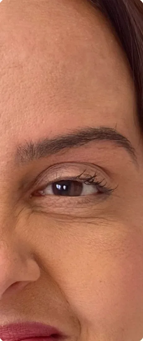 Depois: Suavizar as linhas ao redor dos olhos. Toxina botulínica, Dra. Marina Albuquerque, Maceió