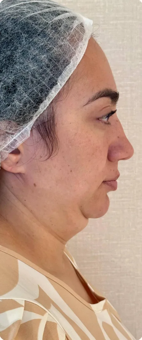 Antes: Reduzir o volume da papada. Lipoaspiração de papada HD, Dra. Marina Albuquerque, Maceió