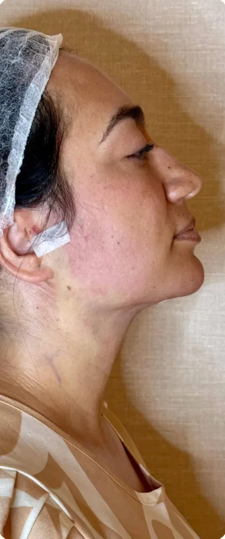 Depois: Reduzir o volume da papada. Lipoaspiração de papada HD, Dra. Marina Albuquerque, Maceió