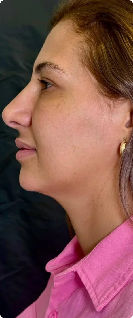 Antes: Revelar a linha da mandíbula. Lipoaspiração de papada HD, Dra. Marina Albuquerque, Maceió