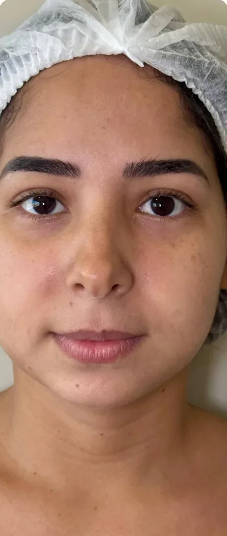 Antes: Ganhar contorno num rosto arredondado. Full Face, Dra. Marina Albuquerque, Maceió