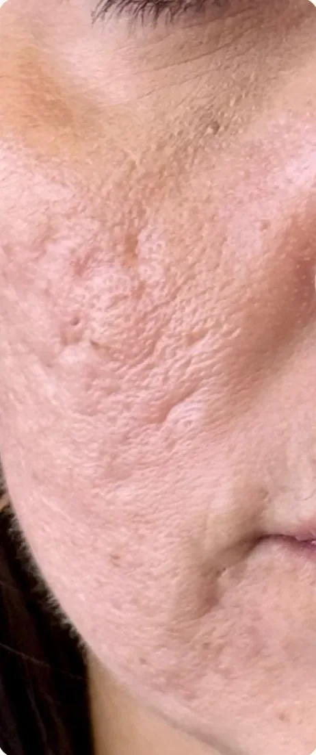 Antes: Suavizar as cicatrizes de acne. Subincisão, microagulhamento e peelings, Dra. Marina Albuquerque, Maceió