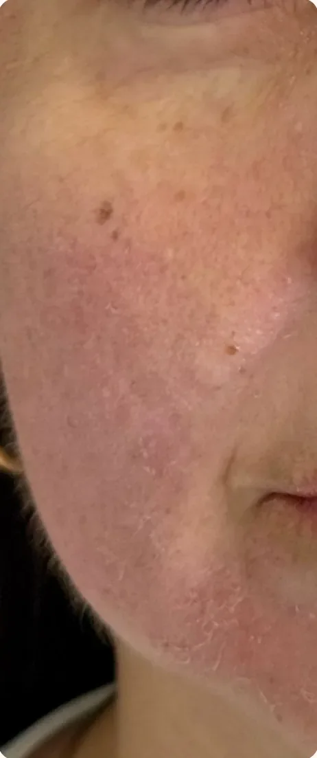 Depois: Suavizar as cicatrizes de acne. Subincisão, microagulhamento e peelings, Dra. Marina Albuquerque, Maceió