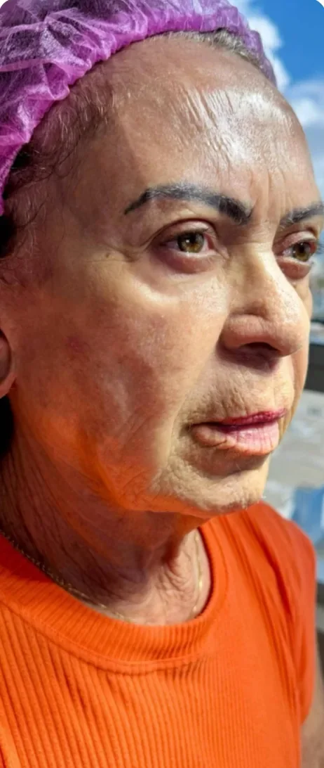 Antes: Rejuvenescer o rosto depois da perda de peso. Full Face, Dra. Marina Albuquerque, Maceió