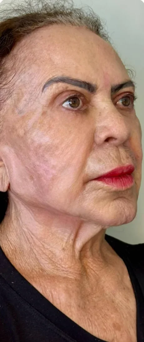 Depois: Rejuvenescer o rosto depois da perda de peso. Full Face, Dra. Marina Albuquerque, Maceió