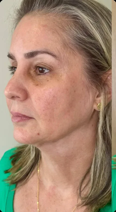 Antes: Recuperar a sustentação do rosto. Full Face e bioestimulador, Dra. Marina Albuquerque, Maceió