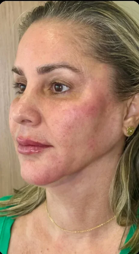 Depois: Recuperar a sustentação do rosto. Full Face e bioestimulador, Dra. Marina Albuquerque, Maceió