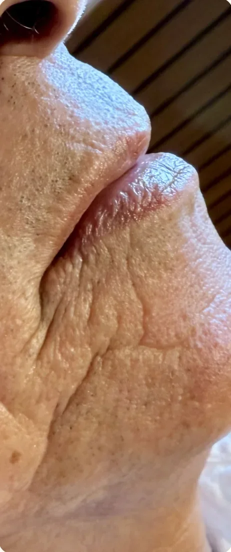 Antes: Recuperar volume e suavizar as linhas ao redor da boca. Preenchimento labial, Dra. Marina Albuquerque, Maceió