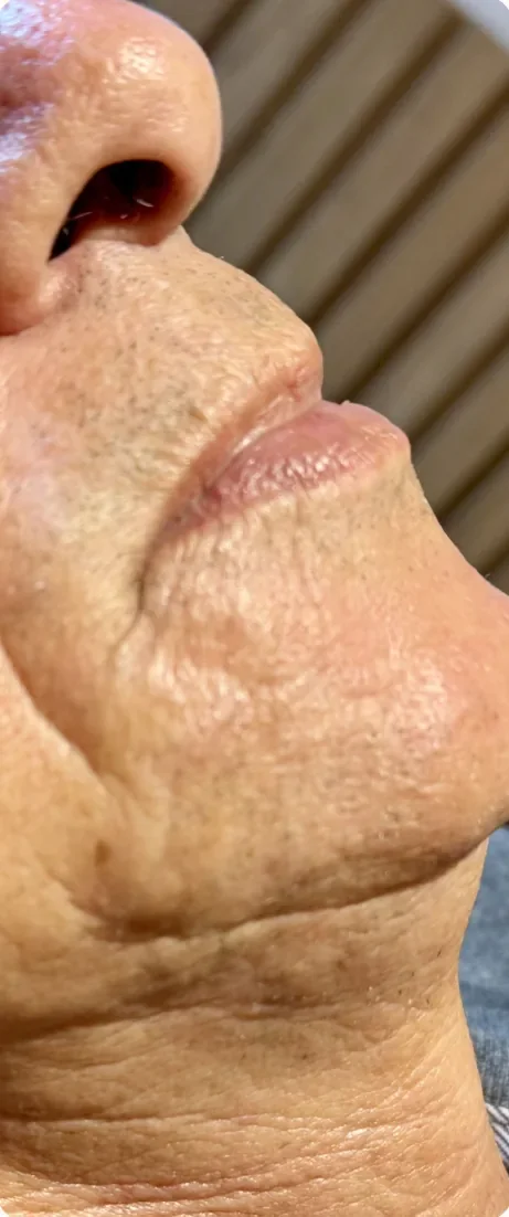 Depois: Recuperar volume e suavizar as linhas ao redor da boca. Preenchimento labial, Dra. Marina Albuquerque, Maceió