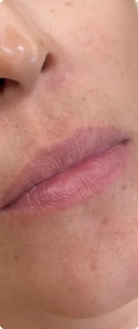 Antes: Ganhar volume e desenho nos lábios. Preenchimento labial, Dra. Marina Albuquerque, Maceió