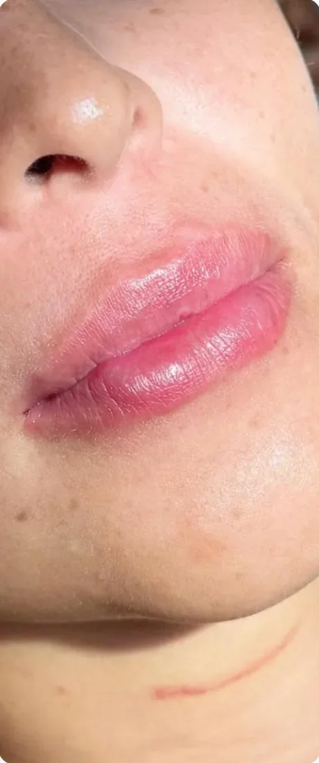 Depois: Ganhar volume e desenho nos lábios. Preenchimento labial, Dra. Marina Albuquerque, Maceió