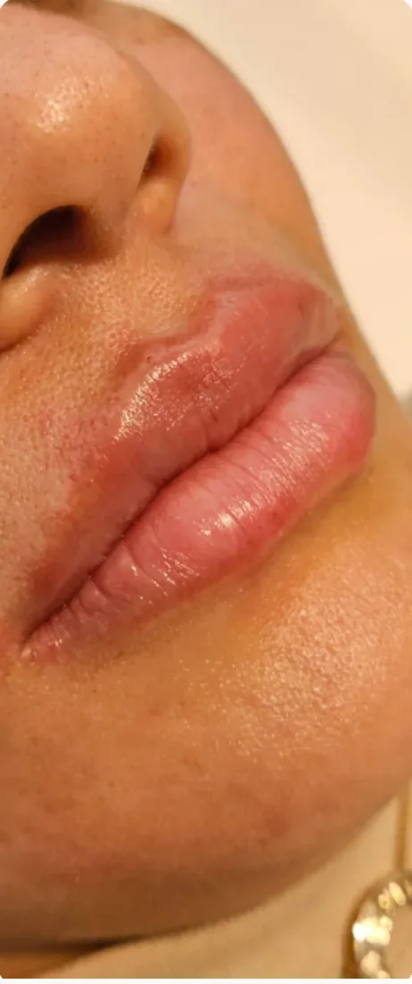 Depois: Recuperar o volume dos lábios. Preenchimento labial, Dra. Marina Albuquerque, Maceió