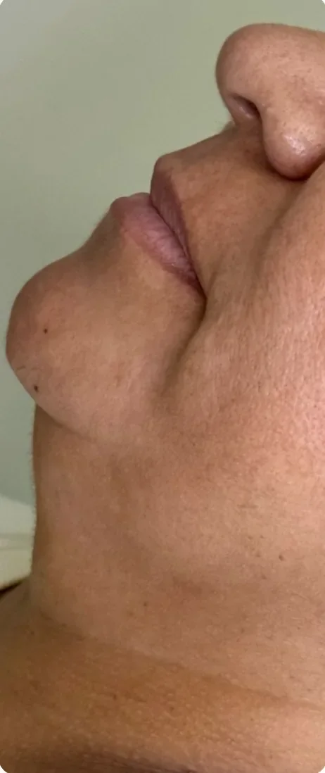 Antes: Definir o contorno da mandíbula. Lipo de papada e preenchimento de mento, Dra. Marina Albuquerque, Maceió