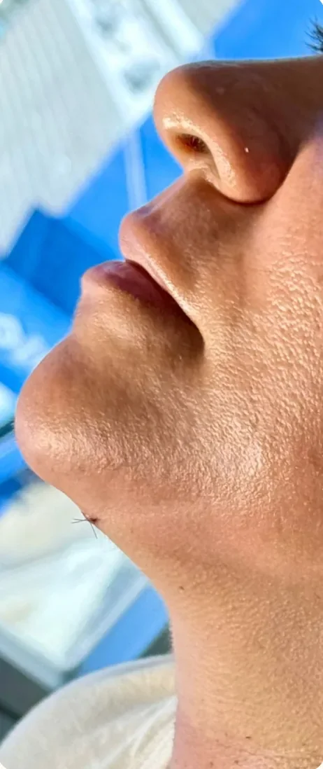 Depois: Definir o contorno da mandíbula. Lipo de papada e preenchimento de mento, Dra. Marina Albuquerque, Maceió