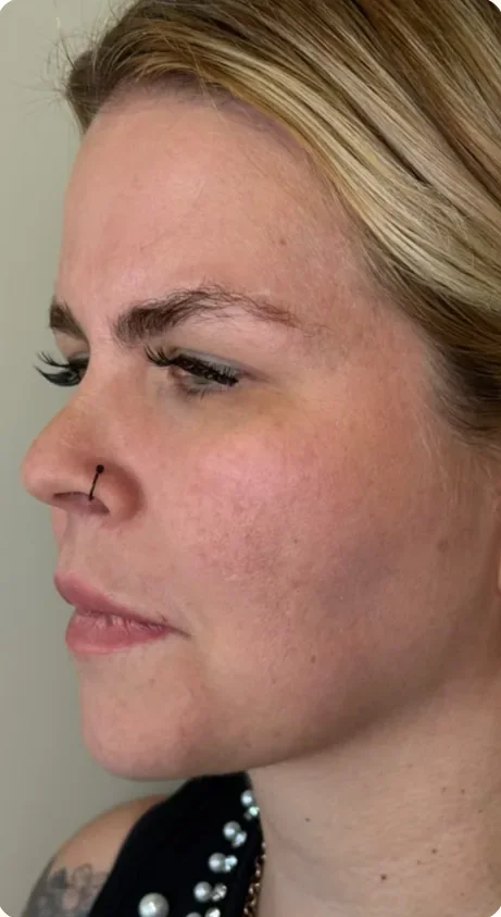 Antes: Firmar os contornos que perderam definição. Full Face e bioestimulador, Dra. Marina Albuquerque, Maceió