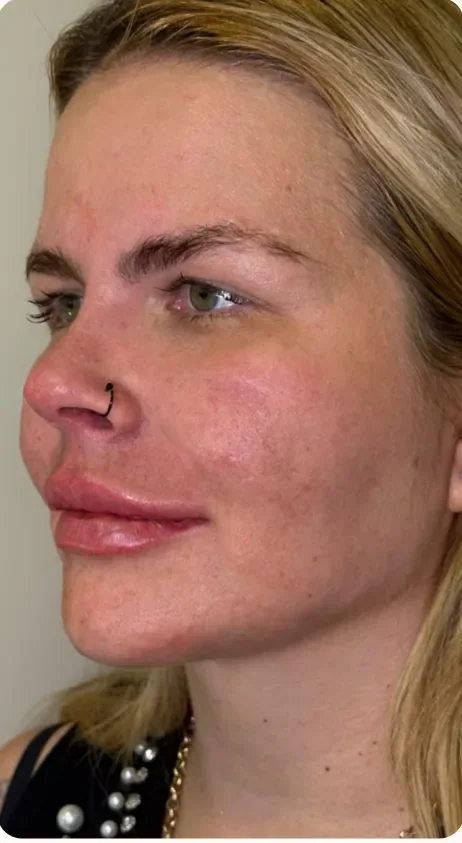 Depois: Firmar os contornos que perderam definição. Full Face e bioestimulador, Dra. Marina Albuquerque, Maceió