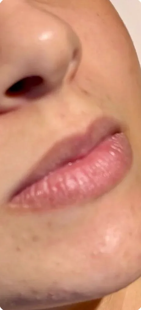 Antes: Definir o contorno dos lábios. Preenchimento labial, Dra. Marina Albuquerque, Maceió