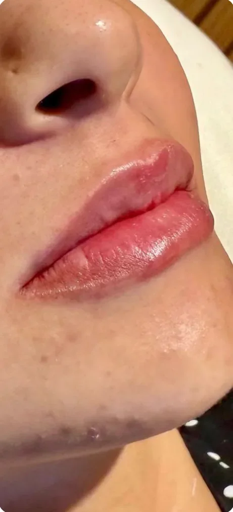 Depois: Definir o contorno dos lábios. Preenchimento labial, Dra. Marina Albuquerque, Maceió