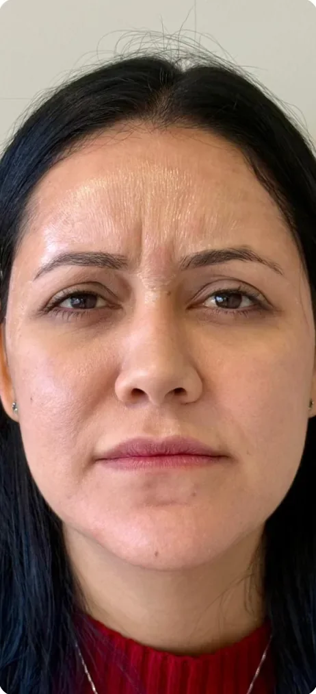 Antes: Tirar o ar de cansaço do olhar e definir o queixo. Full Face, Dra. Marina Albuquerque, Maceió