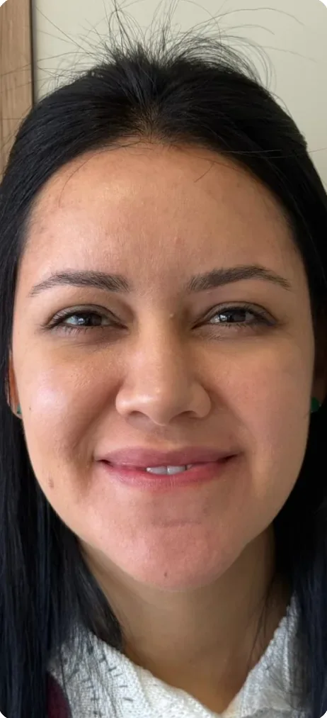 Depois: Tirar o ar de cansaço do olhar e definir o queixo. Full Face, Dra. Marina Albuquerque, Maceió