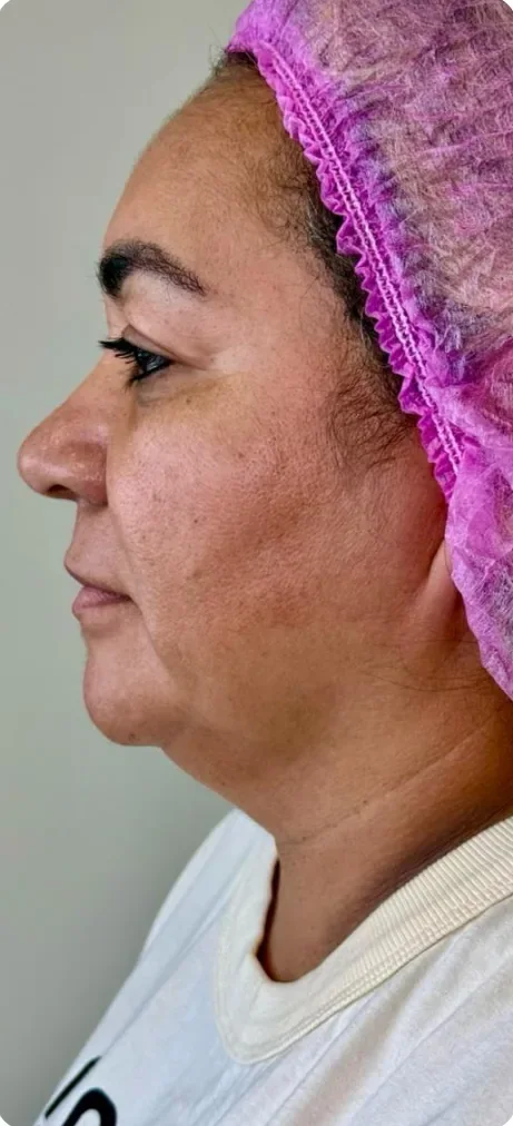 Antes: Reduzir o volume da papada. Lipoaspiração, Dra. Marina Albuquerque, Maceió