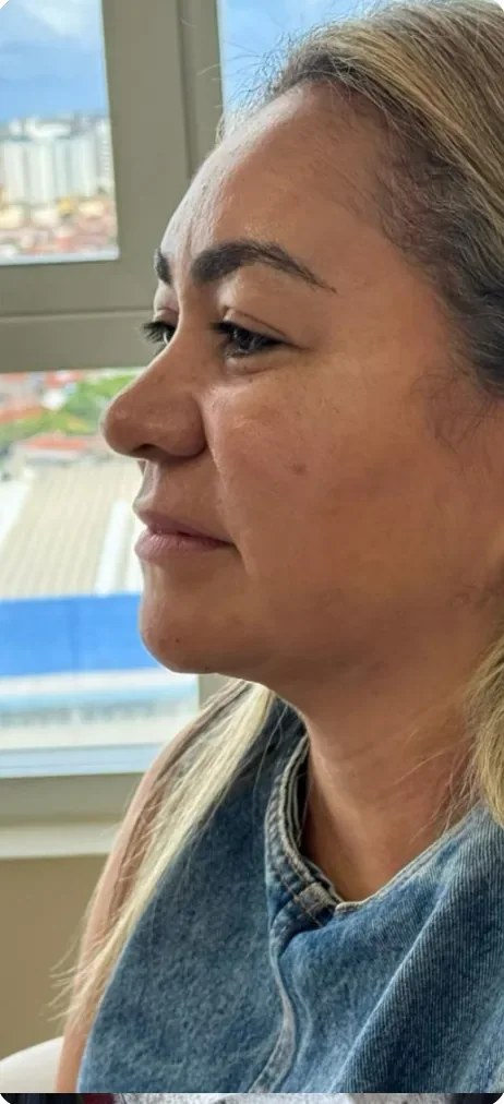 Depois: Reduzir o volume da papada. Lipoaspiração, Dra. Marina Albuquerque, Maceió