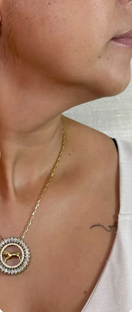 Antes: Tratar o excesso de pele e volume no pescoço. Cervicoplastia, Dra. Marina Albuquerque, Maceió