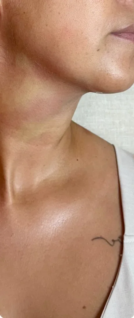 Depois: Tratar o excesso de pele e volume no pescoço. Cervicoplastia, Dra. Marina Albuquerque, Maceió