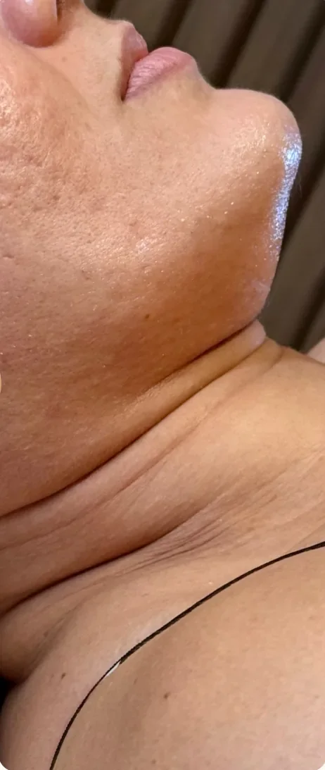 Antes: Revelar a linha da mandíbula. Lipoaspiração de papada HD, Dra. Marina Albuquerque, Maceió