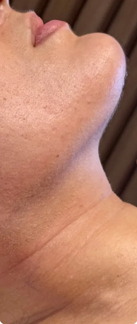 Depois: Revelar a linha da mandíbula. Lipoaspiração de papada HD, Dra. Marina Albuquerque, Maceió