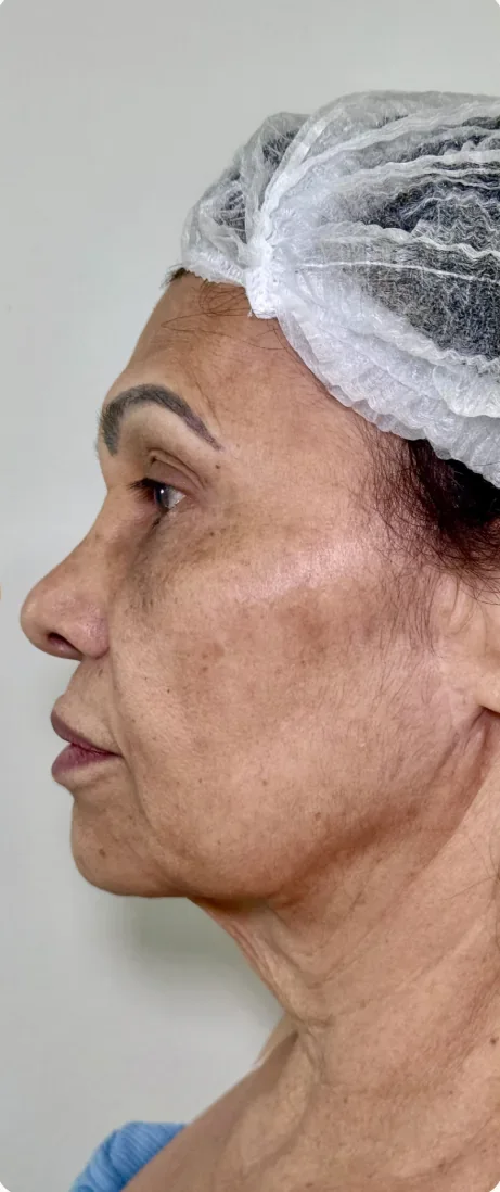 Antes: Tratar o excesso de pele no terço inferior e no pescoço. Lifting cervical, Dra. Marina Albuquerque, Maceió