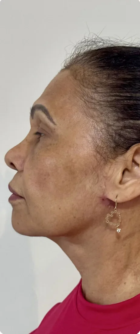 Depois: Tratar o excesso de pele no terço inferior e no pescoço. Lifting cervical, Dra. Marina Albuquerque, Maceió