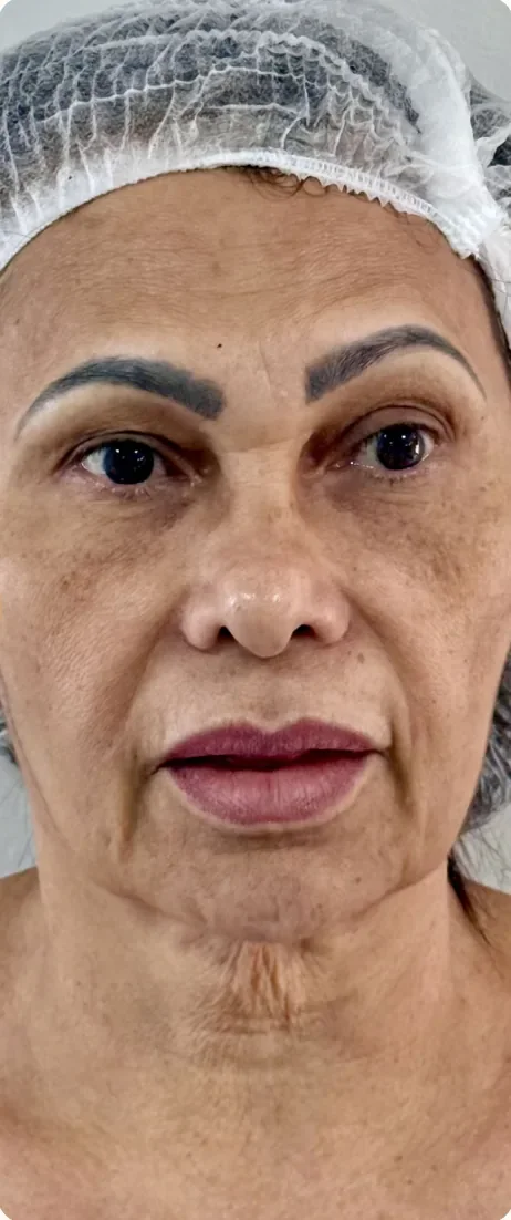 Antes: Suavizar as marcas e recuperar a sustentação. Full Face e bioestimulador, Dra. Marina Albuquerque, Maceió