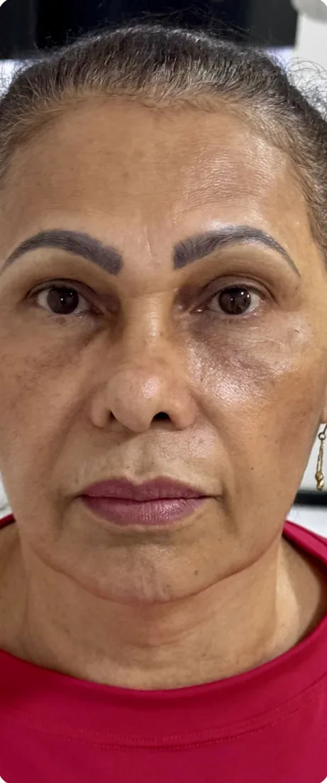 Depois: Suavizar as marcas e recuperar a sustentação. Full Face e bioestimulador, Dra. Marina Albuquerque, Maceió