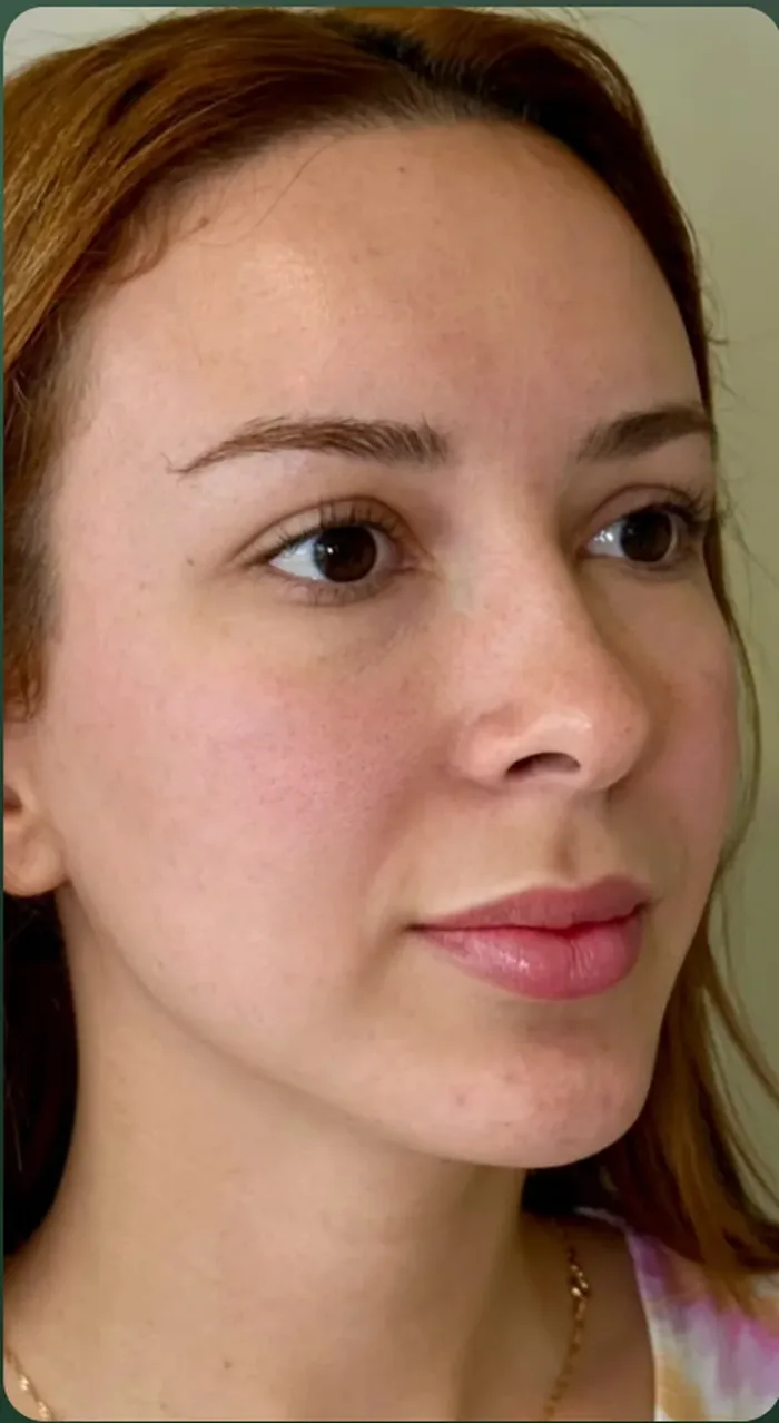 Depois da harmonização facial Full Face com a Dra. Marina Albuquerque